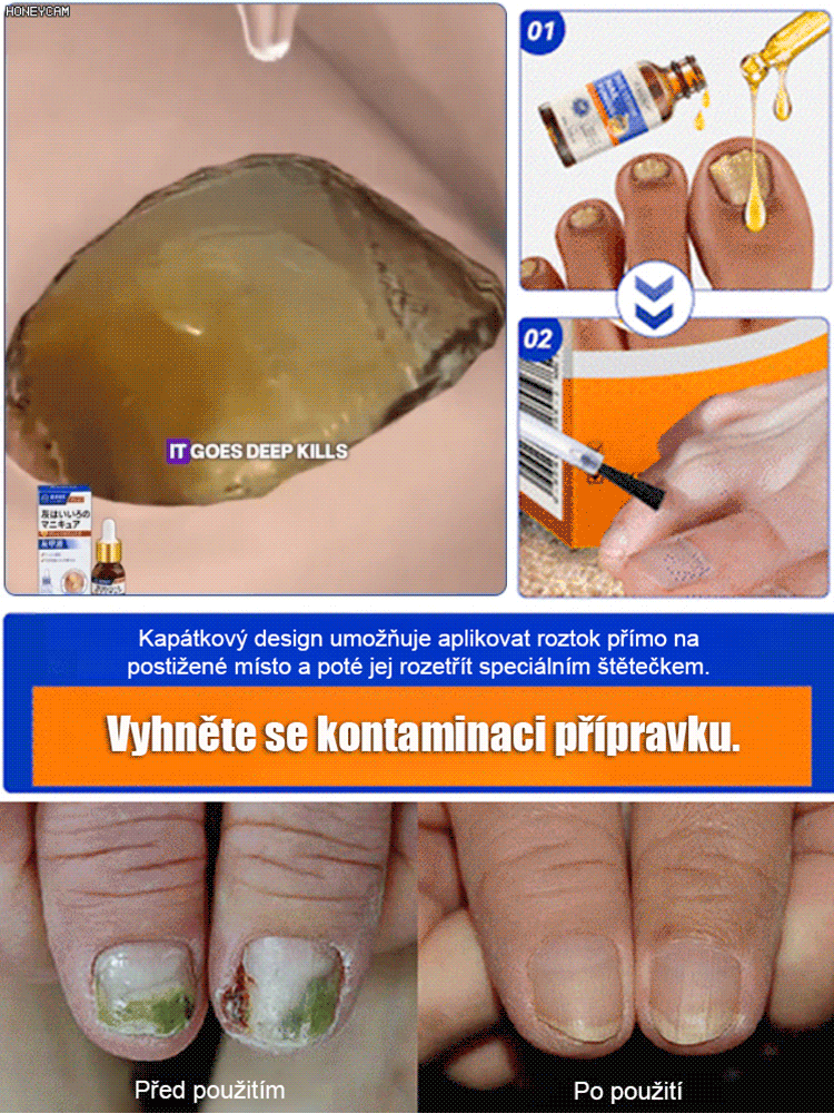 【3denní bezbolestná výměna nehtu】Zahušťující a rozjasňující péče o nehty s plísní Získejte krásné a zdravé nehty už za 3 dny – bez bolesti!