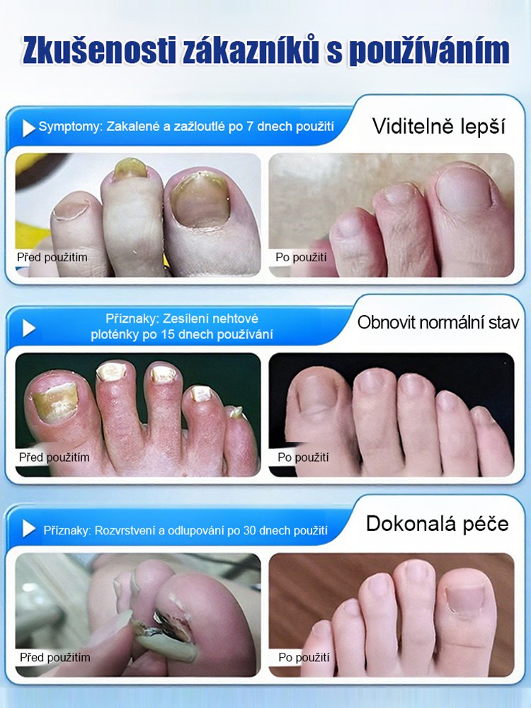 【3denní bezbolestná výměna nehtu】Zahušťující a rozjasňující péče o nehty s plísní Získejte krásné a zdravé nehty už za 3 dny – bez bolesti!